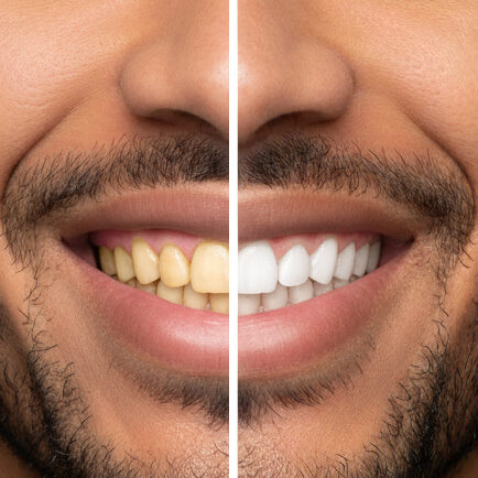 dents
